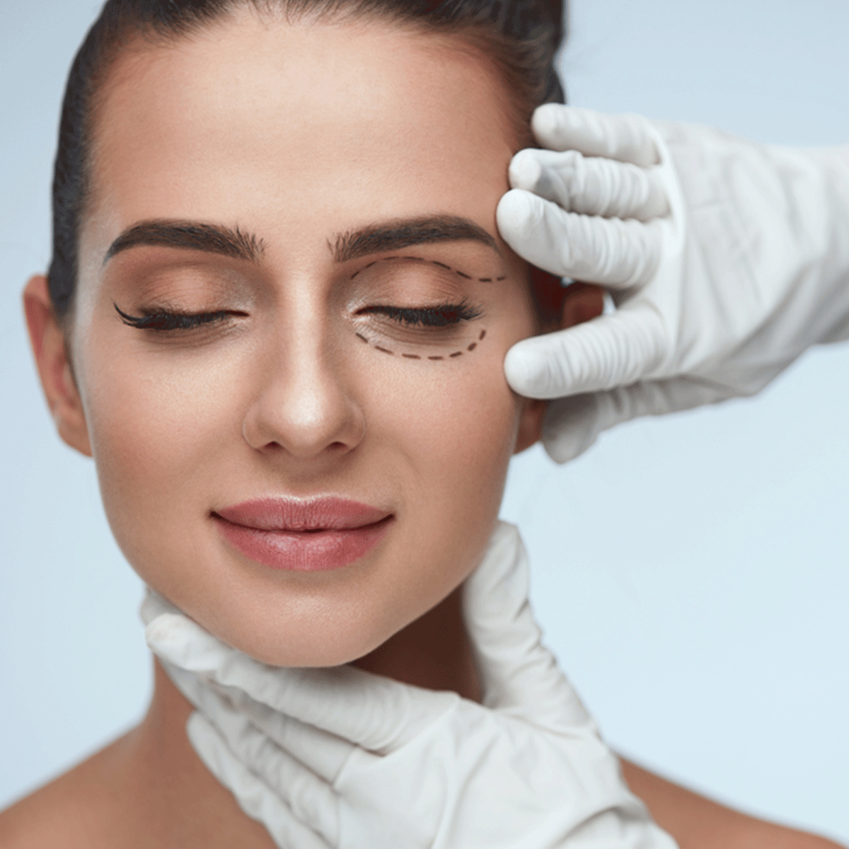 Blefaroplastia